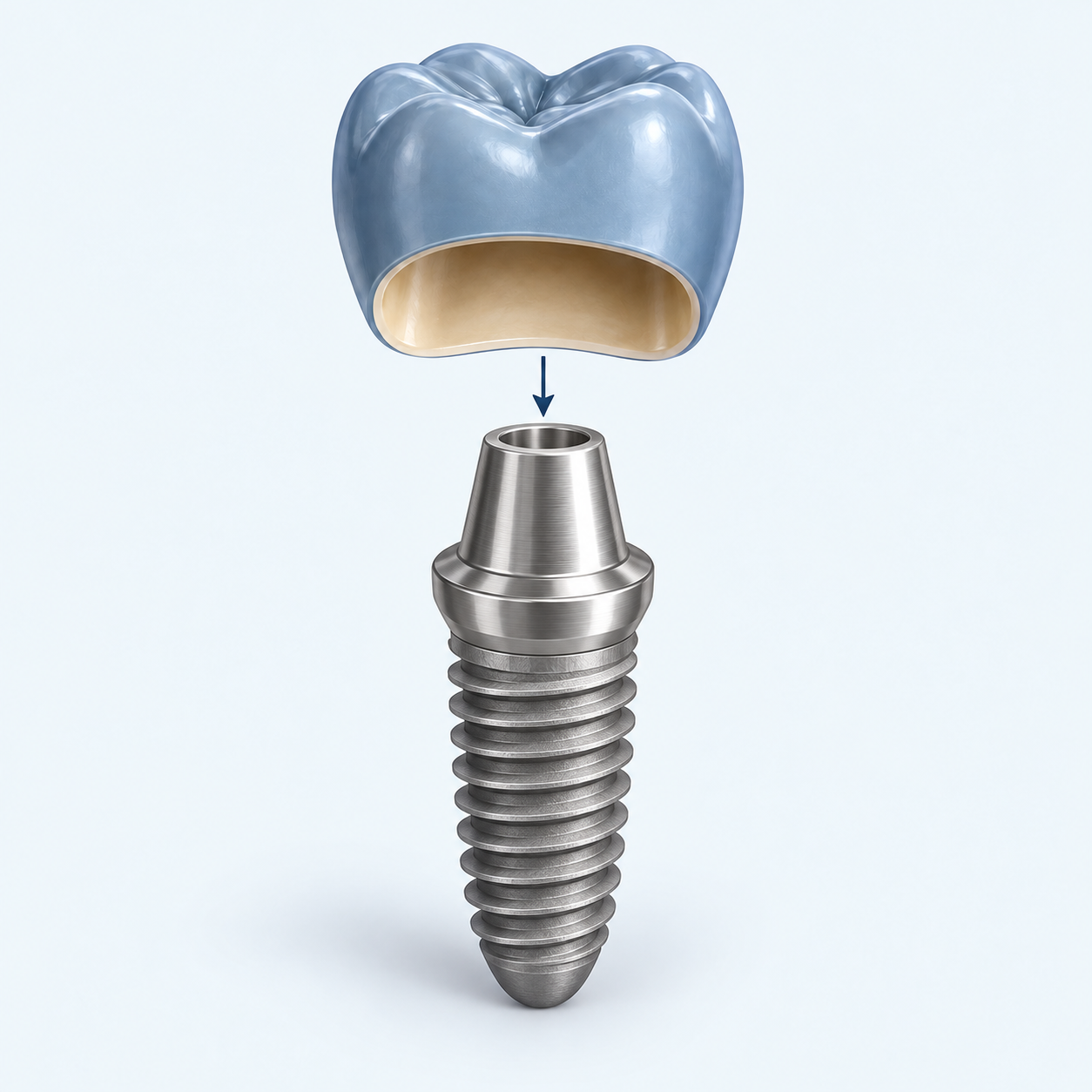 Schéma de principe : une couronne bleue au-dessus d’un pilier métallique relié à un implant dentaire fileté, sans os ni gencive représentés.